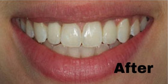 Dental implants — after (Most Dental smile gallery)