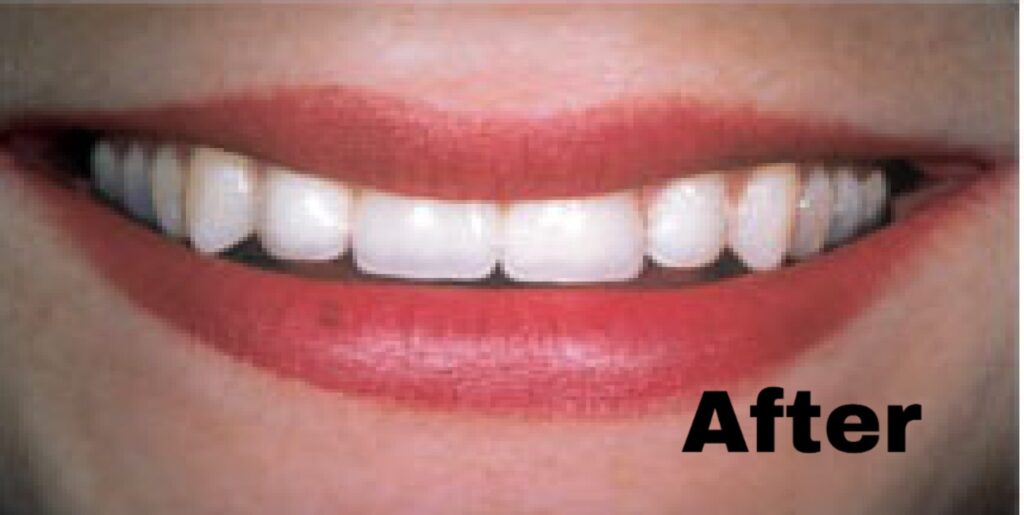 Maryland bridge — after (Most Dental smile gallery)