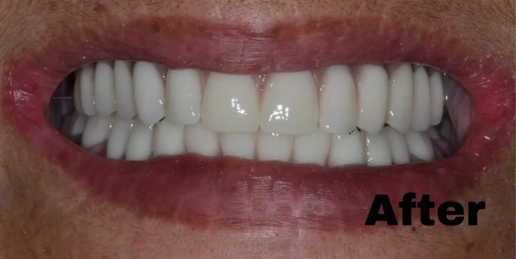 Dentures — after (Most Dental smile gallery)