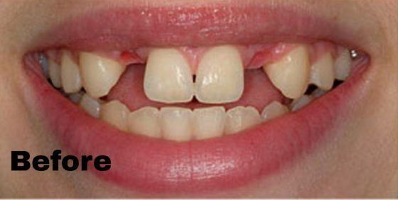 Dental implants — before (Most Dental smile gallery)
