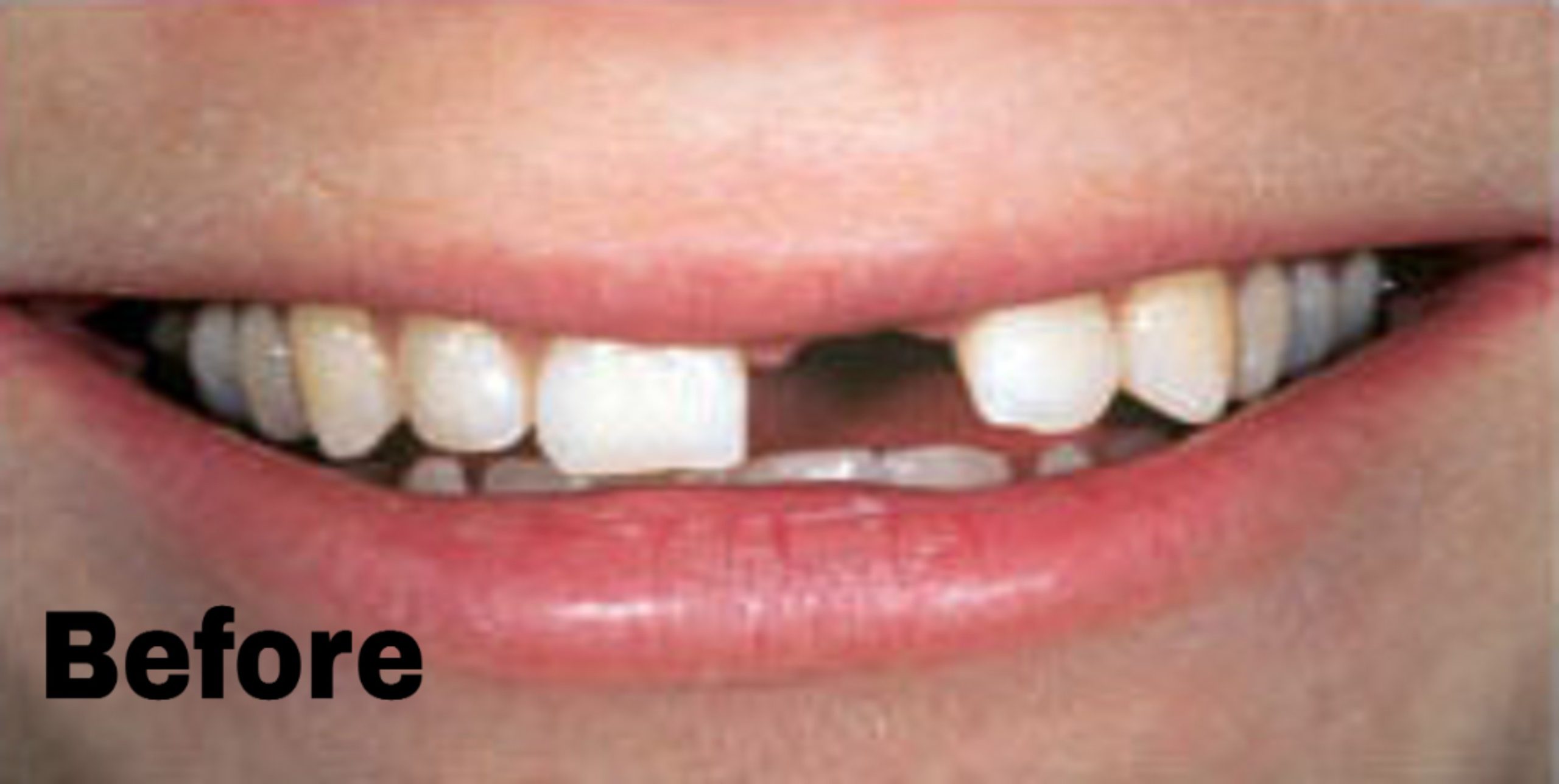 Maryland bridge — before (Most Dental smile gallery)