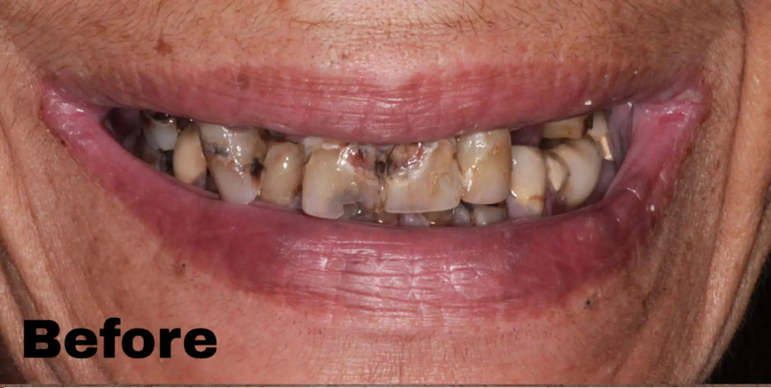 Dentures — before (Most Dental smile gallery)