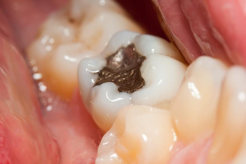Tooth-colored dental fillings
