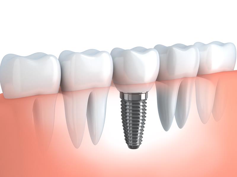 Dental implants to replace missing teeth