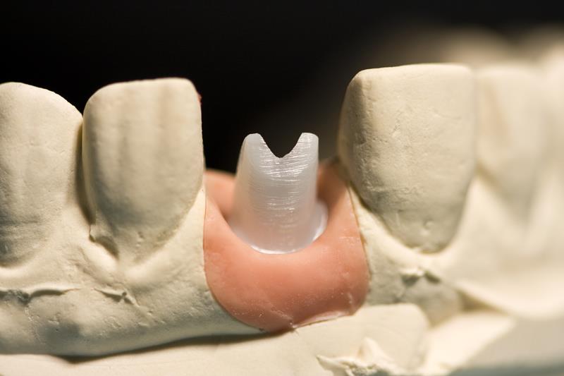 Dental implant restoration